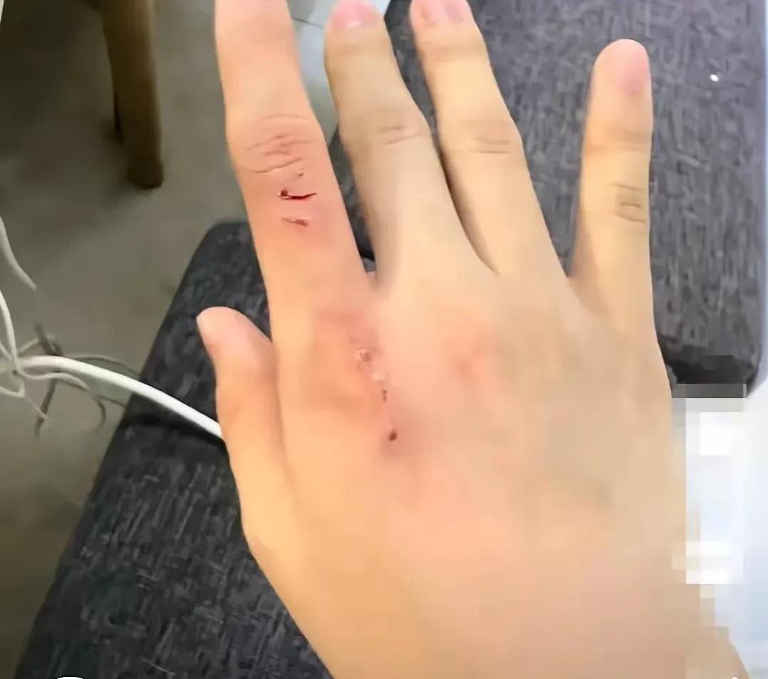 养狗人都会这样说，“我家狗不咬人。”假的！你看狗主人手被自己养的泰迪咬伤了。这