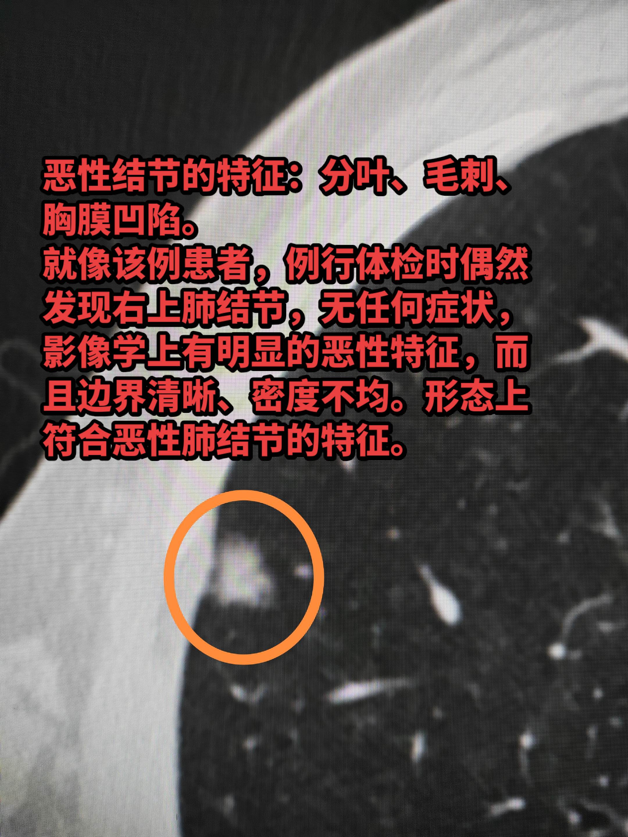 恶性结节的特征：分叶、毛刺、胸膜凹陷。 就像该例患者，例行体检时偶然发...