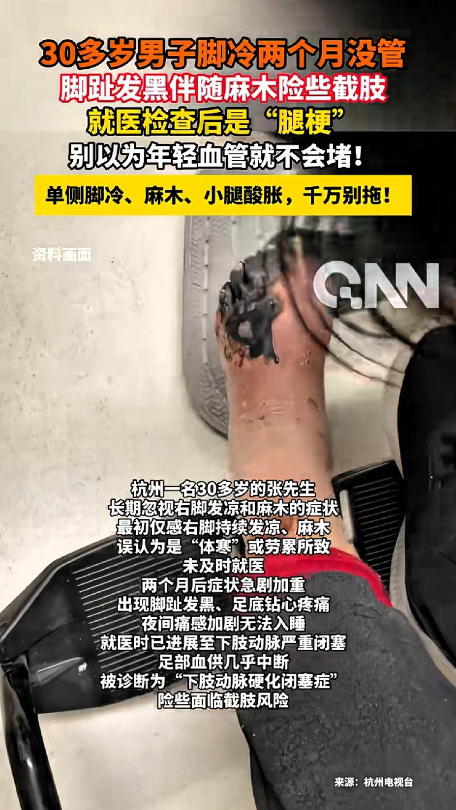 30多岁男子脚冷两个月没管，脚趾发黑并伴随麻木险些截肢，就医检查后是“腿梗”，医