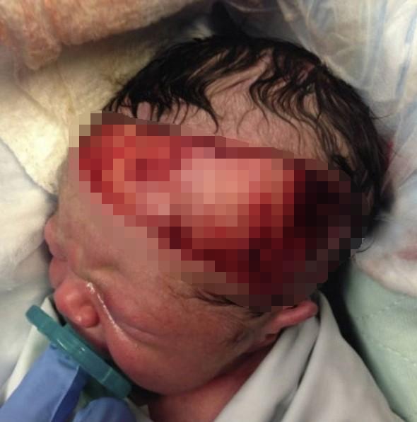 医生为孕妇紧急剖腹, 一刀划下去宝宝头皮被切17公分!