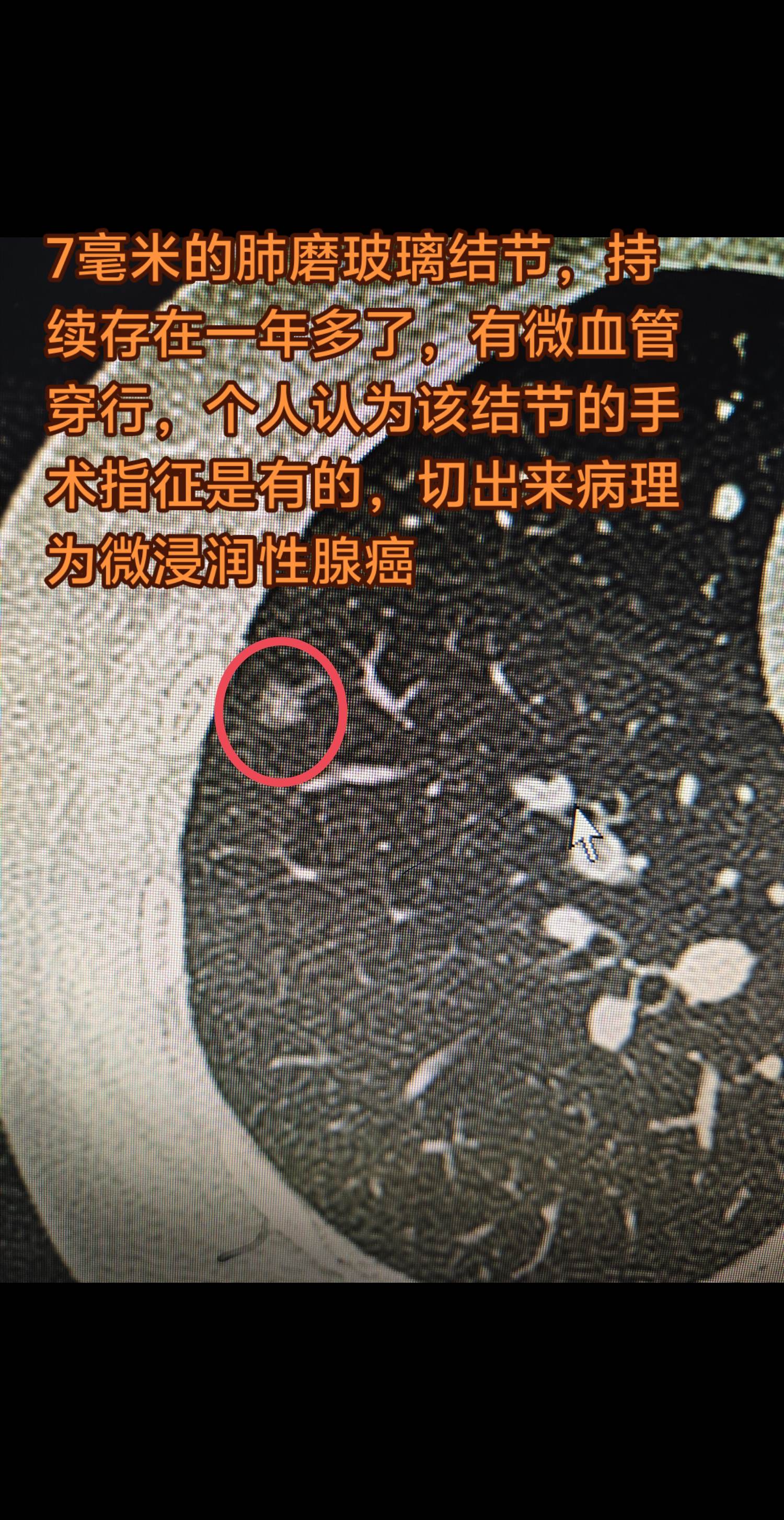 7毫米的肺结节要不要手术呢。7毫米的肺磨玻璃结节，持续存在一年多了，有...