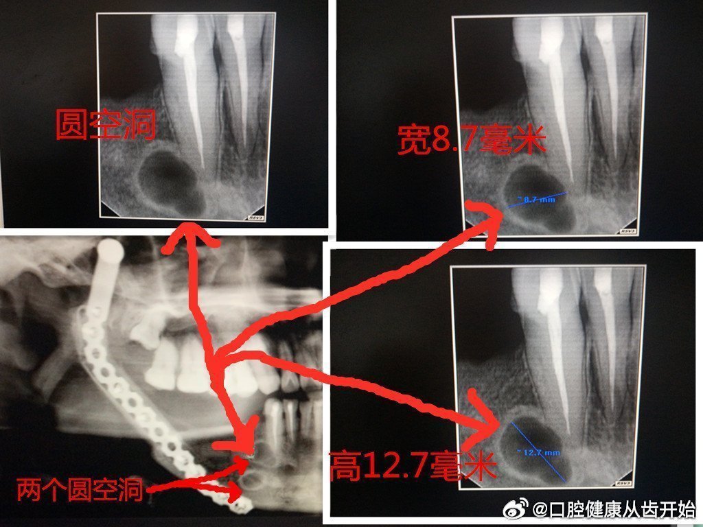 #剖宫产身亡产妇丈夫称很绝望#广东省深圳市北京大学深圳医院做的5次手术，第1次至第3次手术做根管治疗