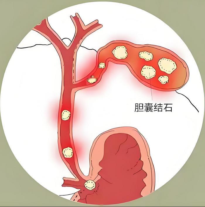 胆结石发作的警报，藏在腹部变化里，多数人都忽略了 不少人以为胆结石痛起来突然