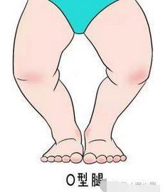 不小心把宝宝害成O型腿