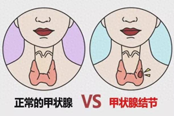 甲状腺结节别乱切！1味散结“王炸”，破瘀、消肿、散痰块，稳住结节不长大我是