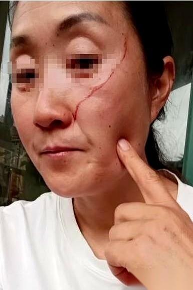 高考结束第二天，亲妈脸被亲闺女硬生生抓掉一块肉，深及真皮层，这辈子注定要留疤了。