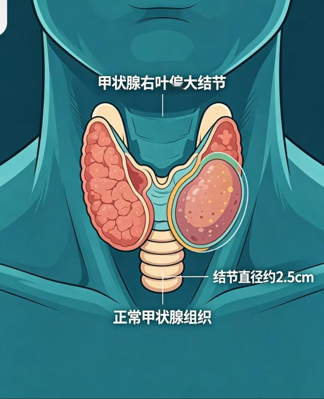 我表妹有甲状腺结节很多年了，这次去检查已经达到4c级，而且有2cm大了，也就是说