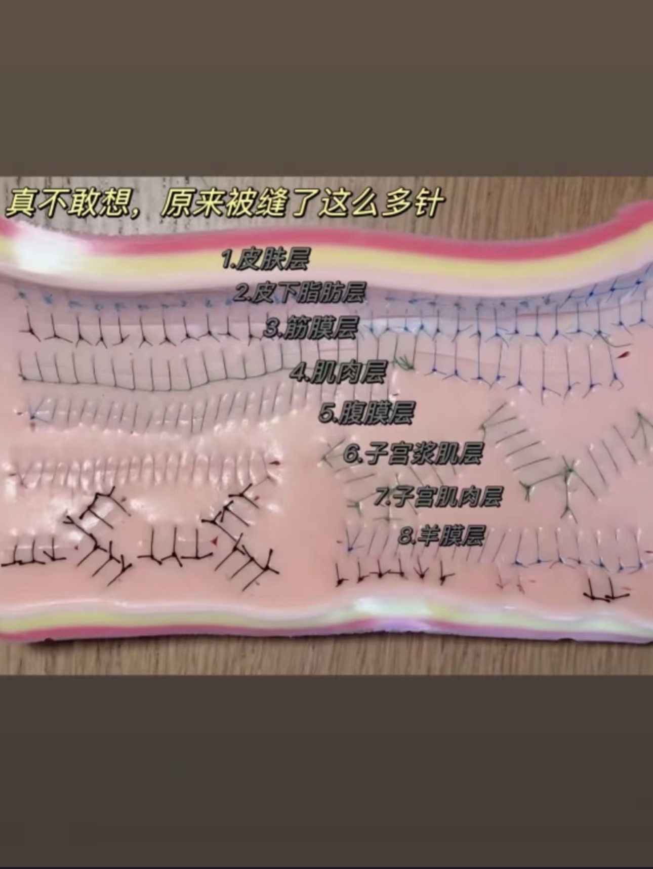 越深的伤疤越不容易愈合我的剖腹产刀口已经一年多了嘛但还是增生了，像一条蚯蚓一样盘