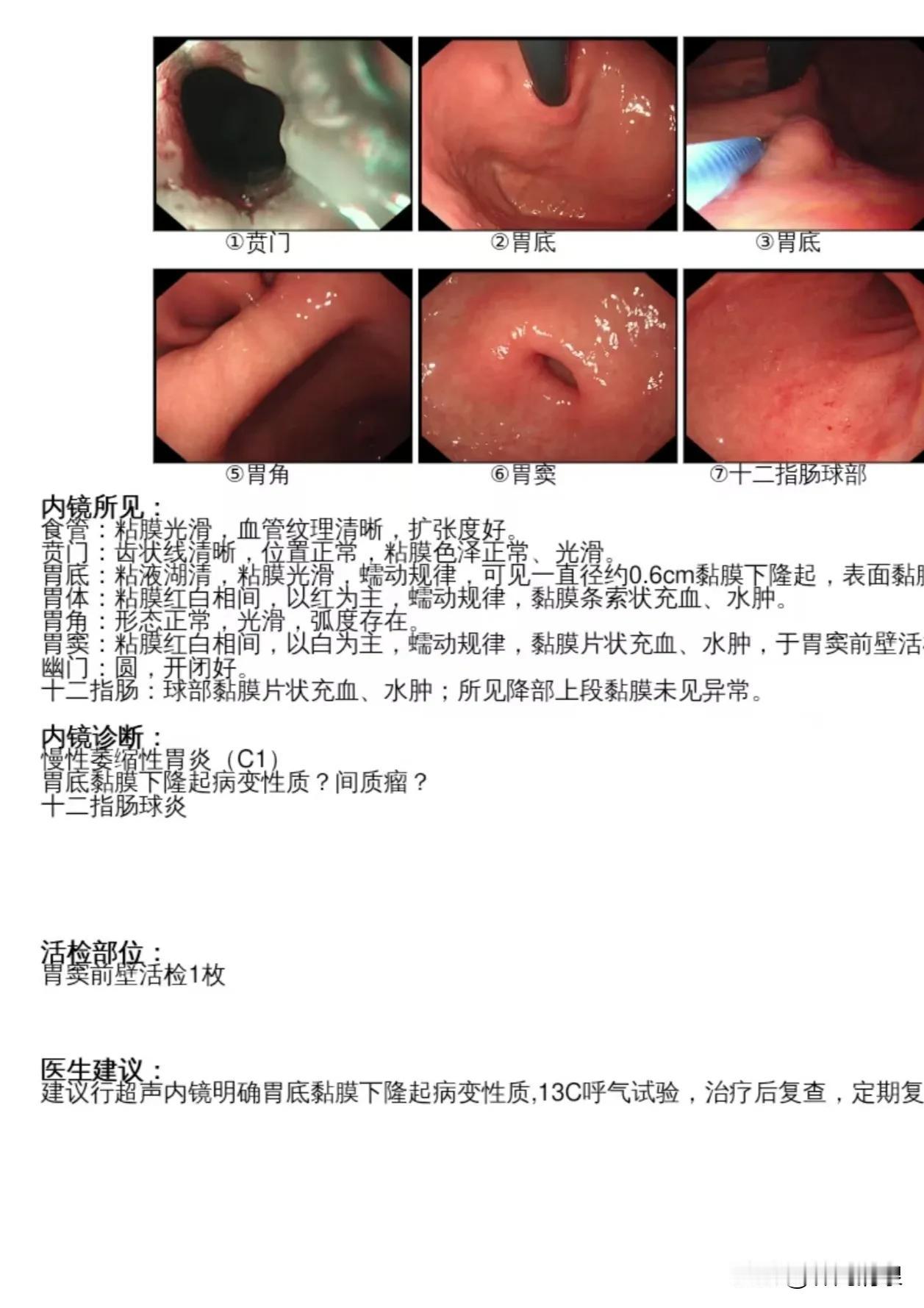 各位大神，这是我家亲戚在小三线城市做的胃镜，大夫说要做个小手术，病理要等一周后才