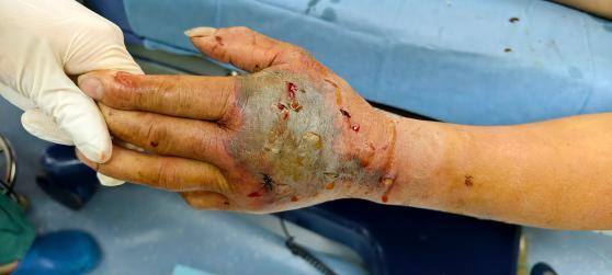 浙江诸暨一名72岁的垂钓爱好者张先生，就因疏忽大意遭遇惊险意外，亲手斩断剧毒眼镜