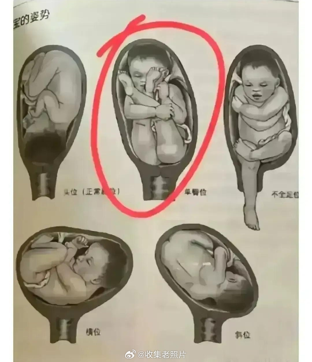 图二胎位放古代，九死一生吧？