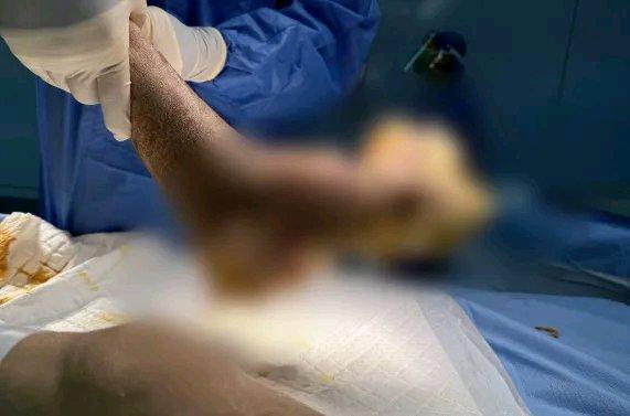 这男子抠脚抠出满脚“菜花”，肛周还有少量，最后确诊是HPV，真是让人惊掉下巴！H