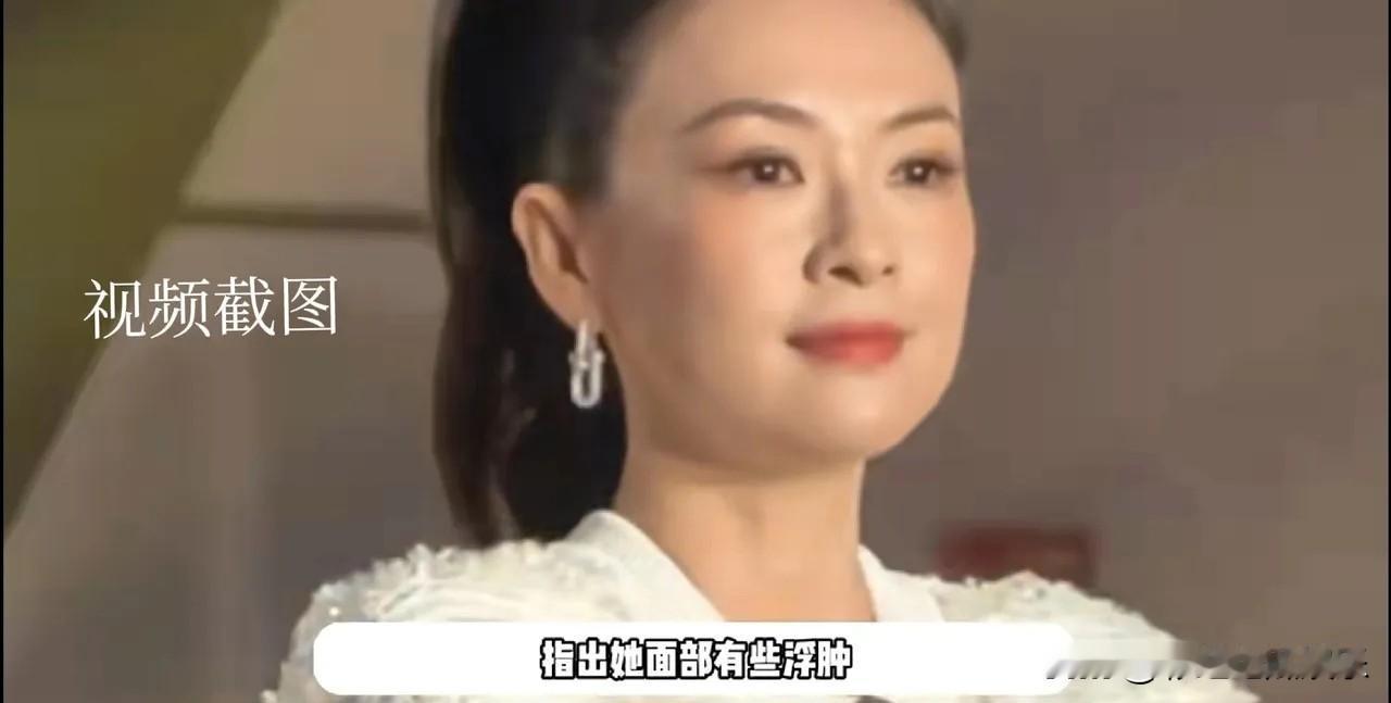 章子怡应该不是发福，可能是医美后遗症，到了年纪靠脸吃饭，她不可能不做医美。这