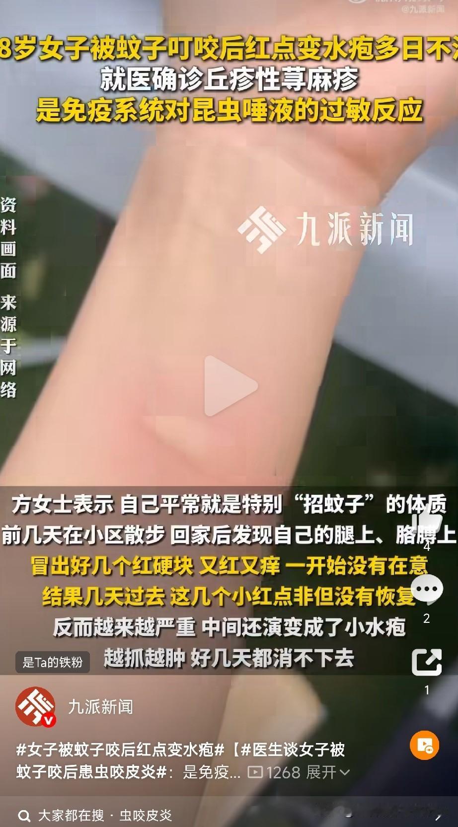 招蚊体质有多惨刚刷到浙大二院这个病例，58岁的方女士楼下散个步，被蚊子咬了几