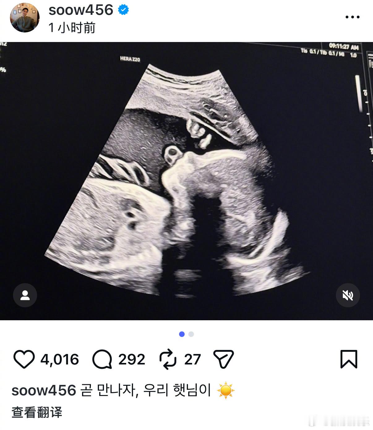 宋承炫宣布当爸宋承炫老婆怀孕21日，前FTISLAND成员宋承炫晒宝宝B超照，