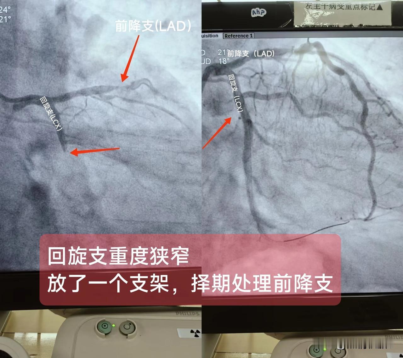 急性ST段抬高型心肌梗死（回旋支、前降支近段重度狭窄）概念：回旋支与前降支共