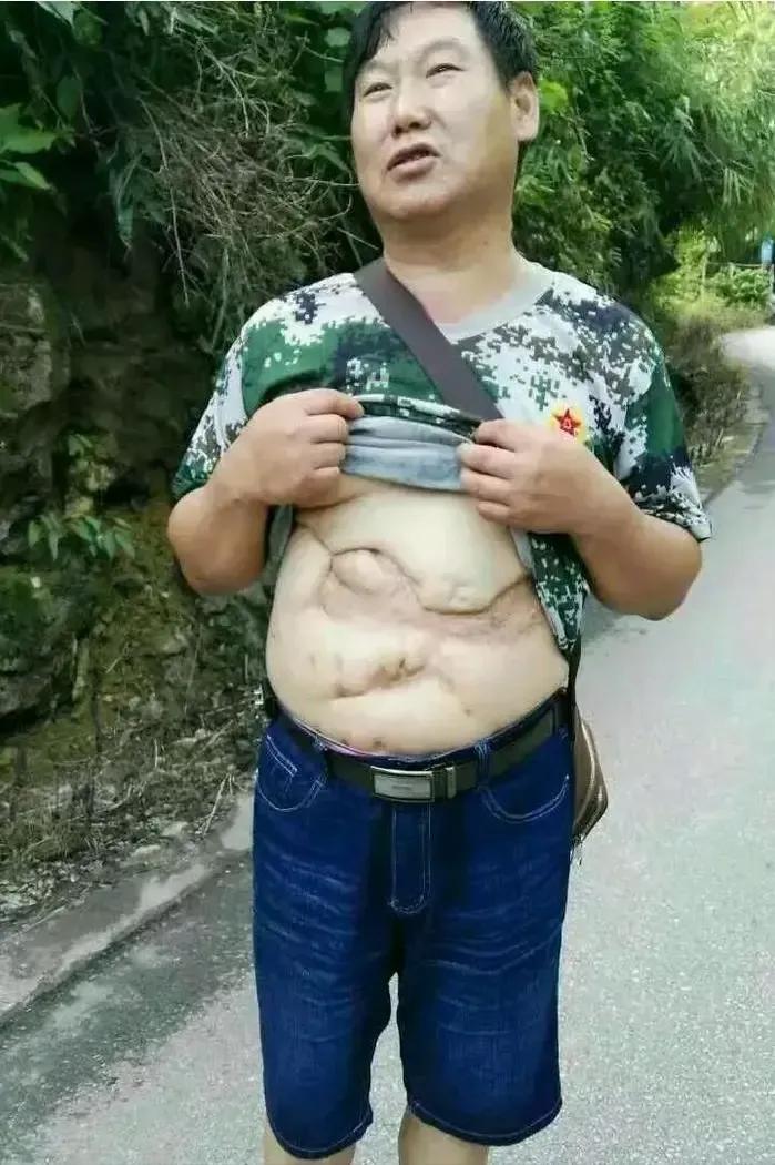 他能活下来就是奇迹！他掀起衣服那一刻，露出肚皮上的“地图”，所有人都为之动容。1
