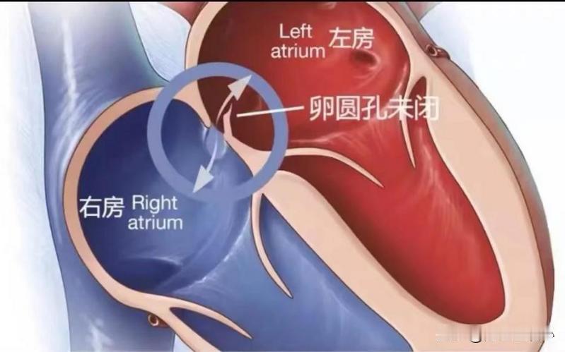 29岁女子突发心梗，心脏造影却发现血管却“干干净净”？没有狭窄也没有斑块。提到