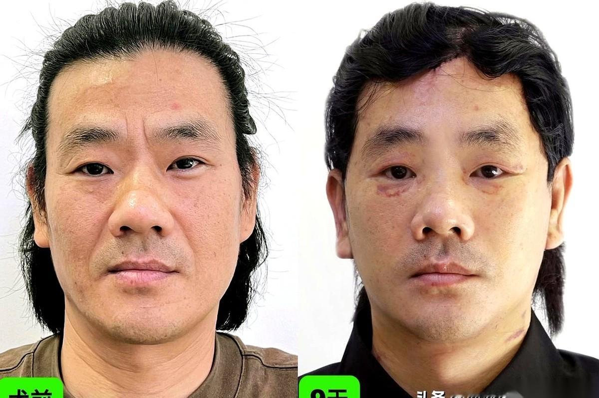 我，47岁，江苏人。门一推开，家里人手里的碗差点掉了。他们死死盯着我头上那个黑