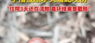 悲剧还是发生了！”四川自贡，一男子在山里掏蘑菇时，手刚伸进去就被原矛头蝮蛇咬伤，