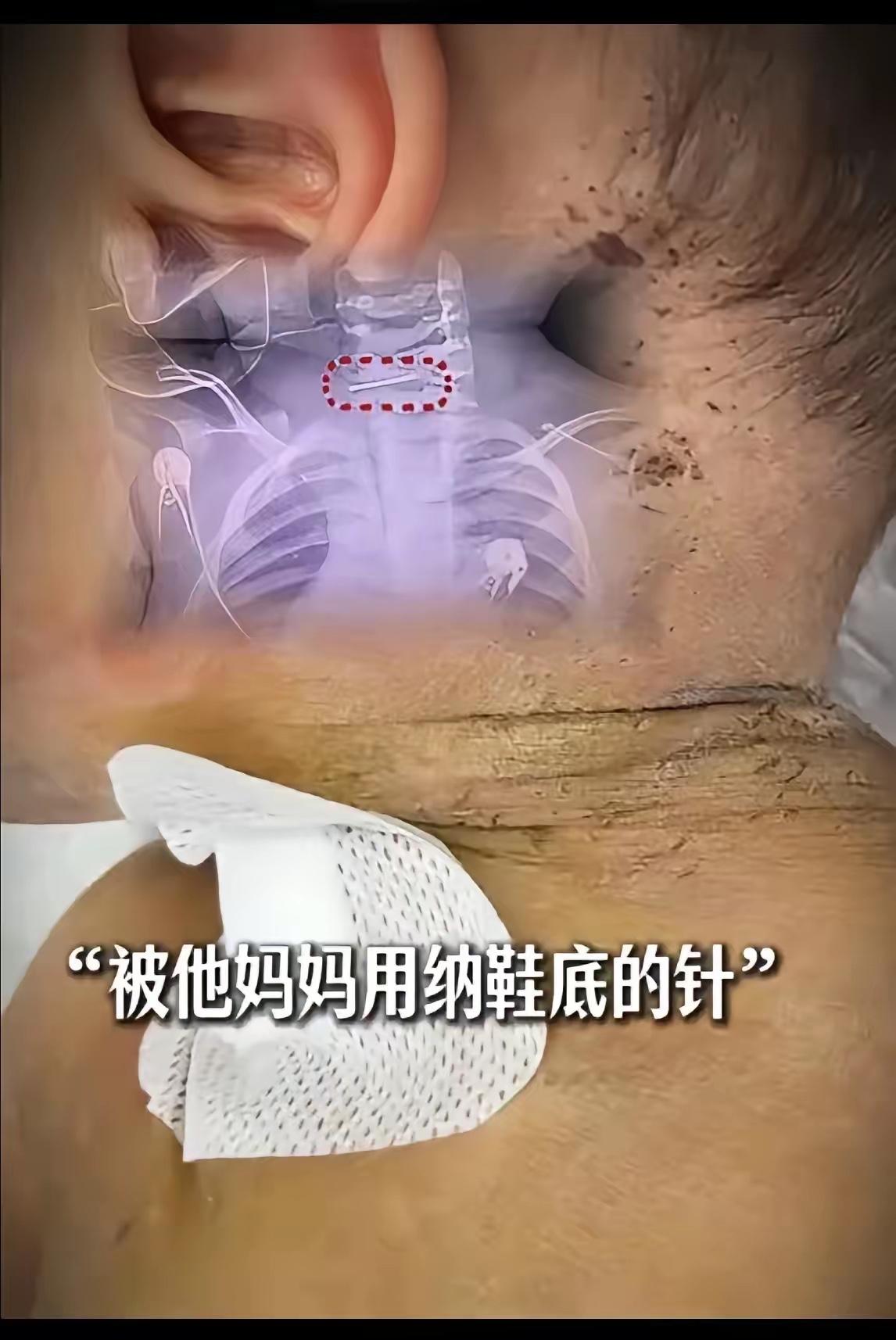 “太可怜了！”十个月大宝宝被妈妈用针扎数百针，只要孩子出现不舒服的状态，或者孩子