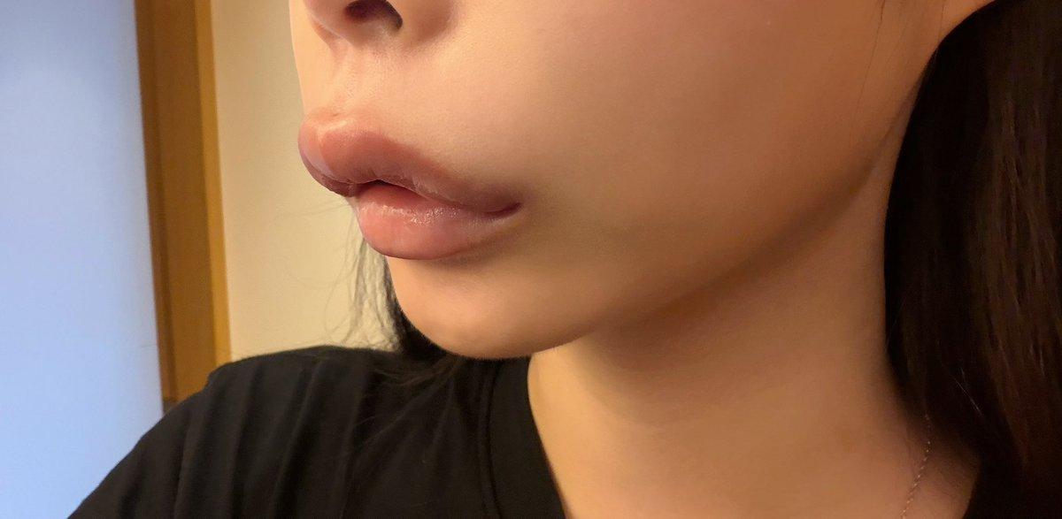 不知道是不是因为昨天开始发烧，做过口内人中缩短术、打过玻尿酸的嘴唇部位，早上起来