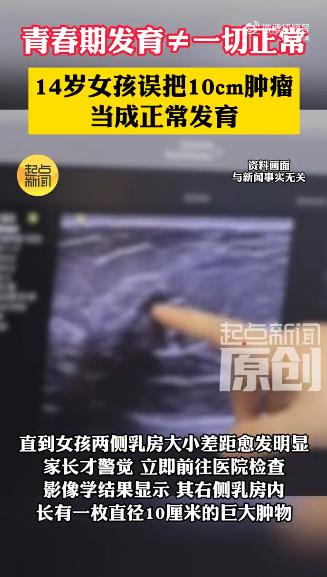 “太吓人了！6月16日报道，西安，14岁初二女生洗澡时无意摸到右侧乳房有个硬块，
