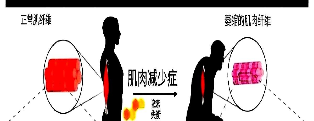 “92岁还在做俯卧撑,我62岁却怕蹲下去起不来。”上周社区体检,老李看着报告