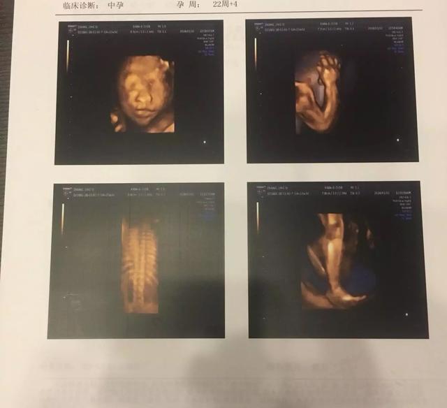 四维20分钟通过, 胎动活泼, 确定男孩, 症状还真的准了