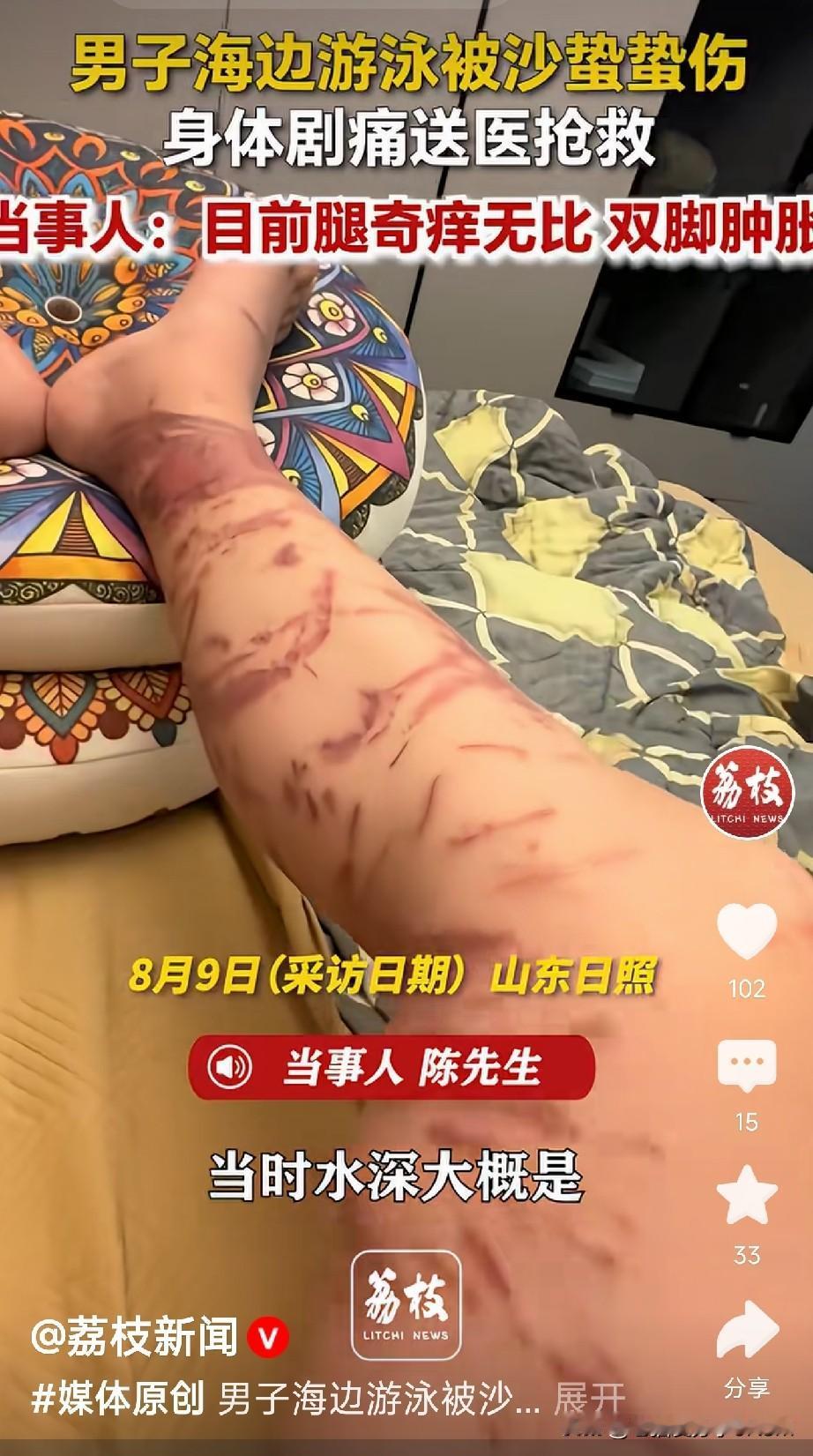 去海边玩，警惕海里的沙蛰近日，陈先生在山东日照万平口海滩游玩时，双腿被沙蜇严
