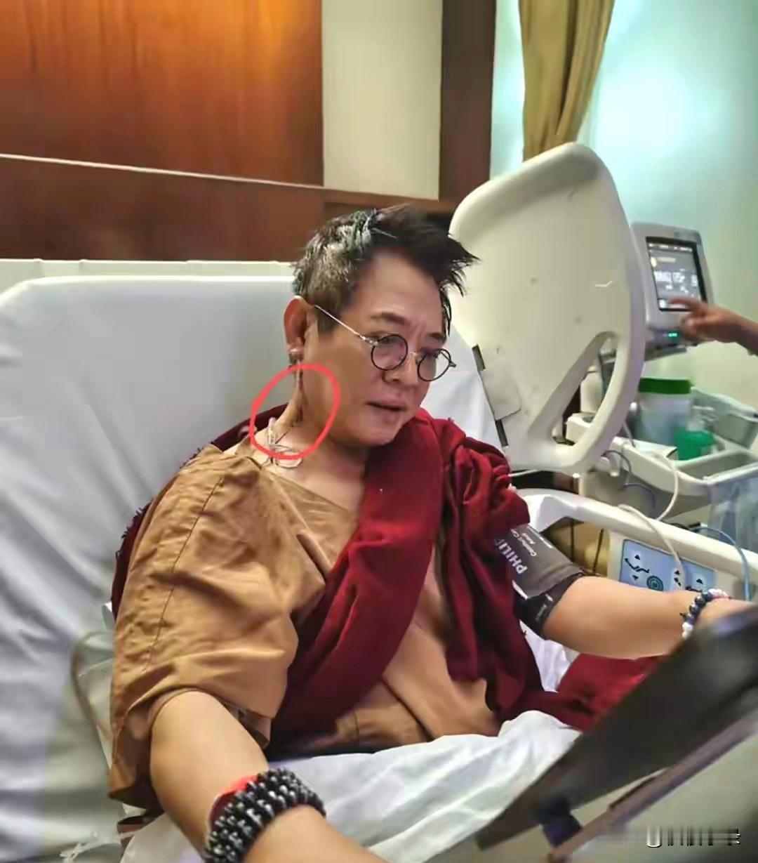 李连杰脖子上开刀，甲亢病情加重了，要知道这是明显的甲亢手术，医生往往在颈脖子上进