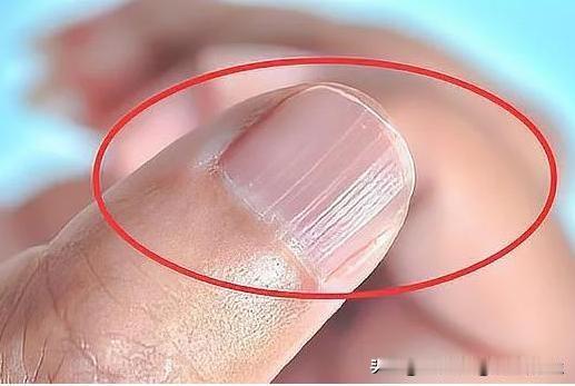 指甲竖纹是咋回事？不少中老年人发现手指甲长出竖纹，心里十分焦