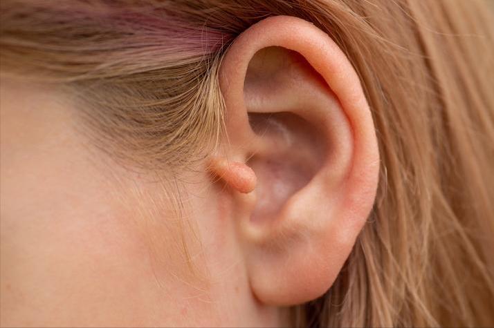 耳朵是心梗的“预警器”？医生：耳朵出现这6个症状，抓紧去医院谁能想到，远离心脏