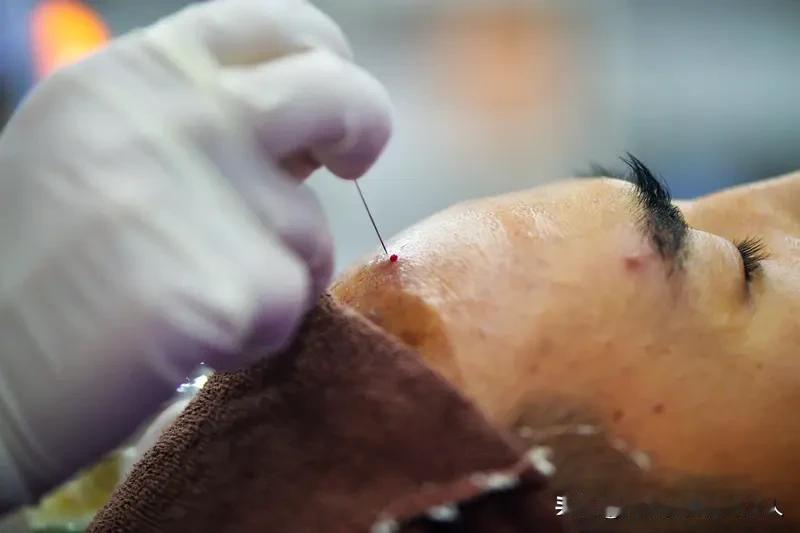 刺络放血三要穴，急救时用得到它们：🩸十宣穴(急救高热、惊厥、中暑)十宣