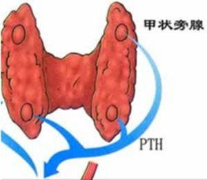 假性甲状旁腺功能减退是什么? 是否需要治疗?