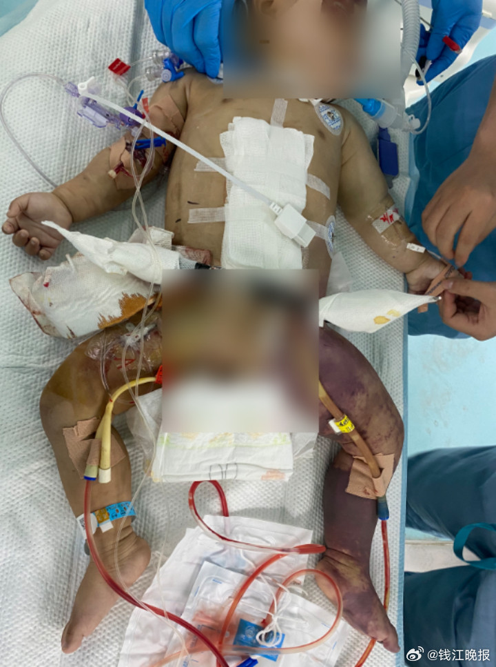 #1岁女儿电动车上被撞飞截肢截骨盆#【太可怜！一家三口骑电动车出行，1岁宝宝被撞