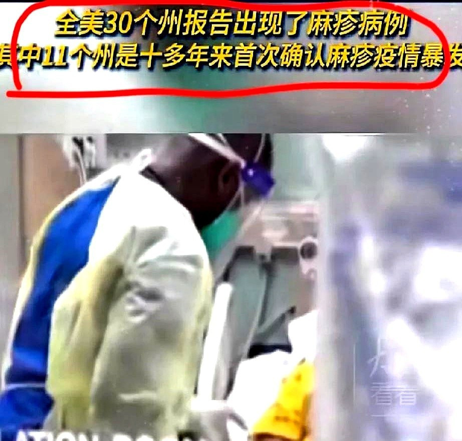 美国麻疹大爆发，疫苗这事别大意天呐撸！美国这是咋了？麻疹