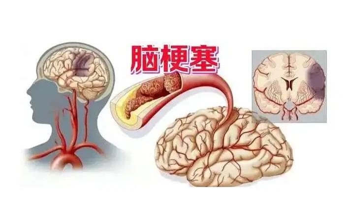 为什么现在脑梗越来越多？医生提醒：饭后少做3件事，劝你改正随着现代生活节奏