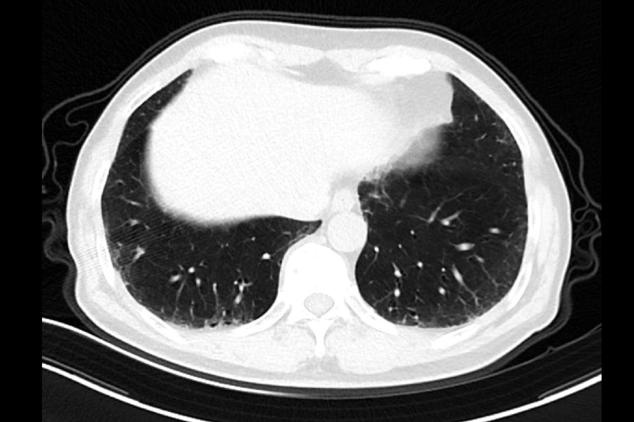 “你早10年来找我，你的肺都不至于这样子”，这是我对一个肺气肿患者心痛的肺腑之言