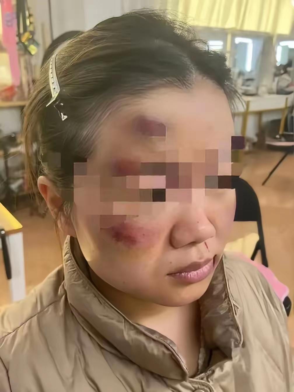 女子在网上吐槽说，她脸上的伤是丈夫用皮带打的，结婚10年了，她挨了丈夫无数次打，