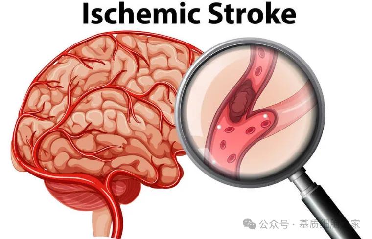 脑血栓错过最佳溶栓时机? —间充质基质细胞带来新希望