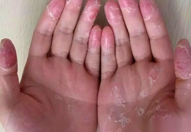 很多人把皮肤发痒当成小事，随手抓一抓，或者翻出半瓶过期的药膏胡乱一抹。结果原本