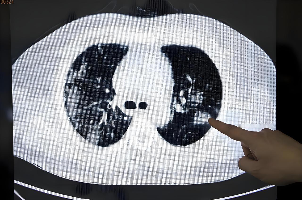 肺结节患者的随访频率需结合结节大小、形态、密度及个体情况综合判定，以尽早发现恶变