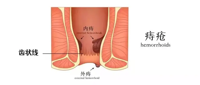 痔疮不做手术能治好吗