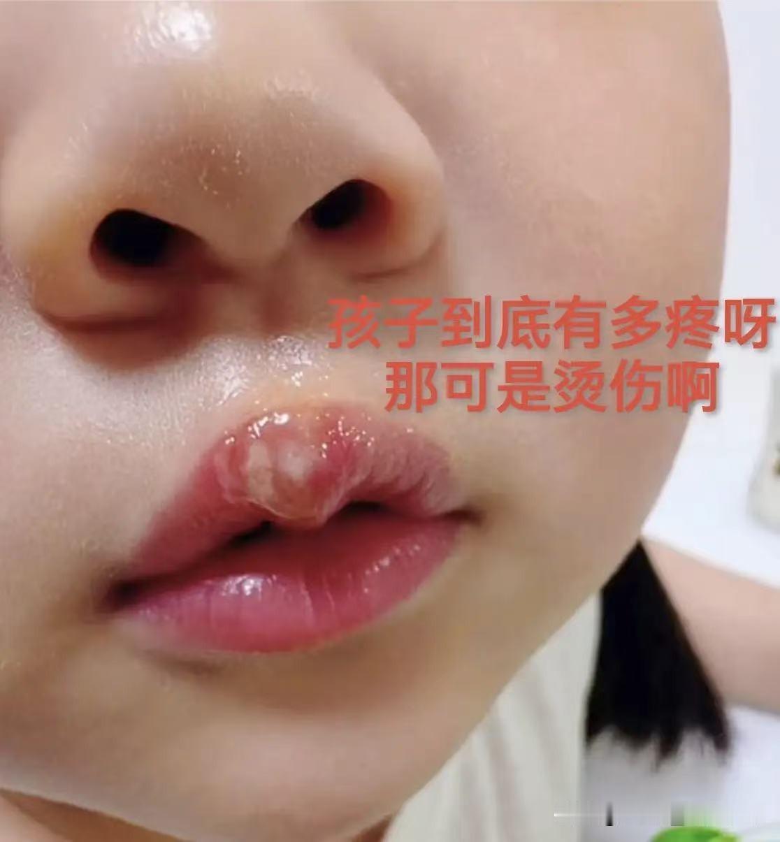 拿热熔胶烫幼儿嘴巴，这位幼师将要面临几大窘境:第一、职业生涯彻底终结。身为幼