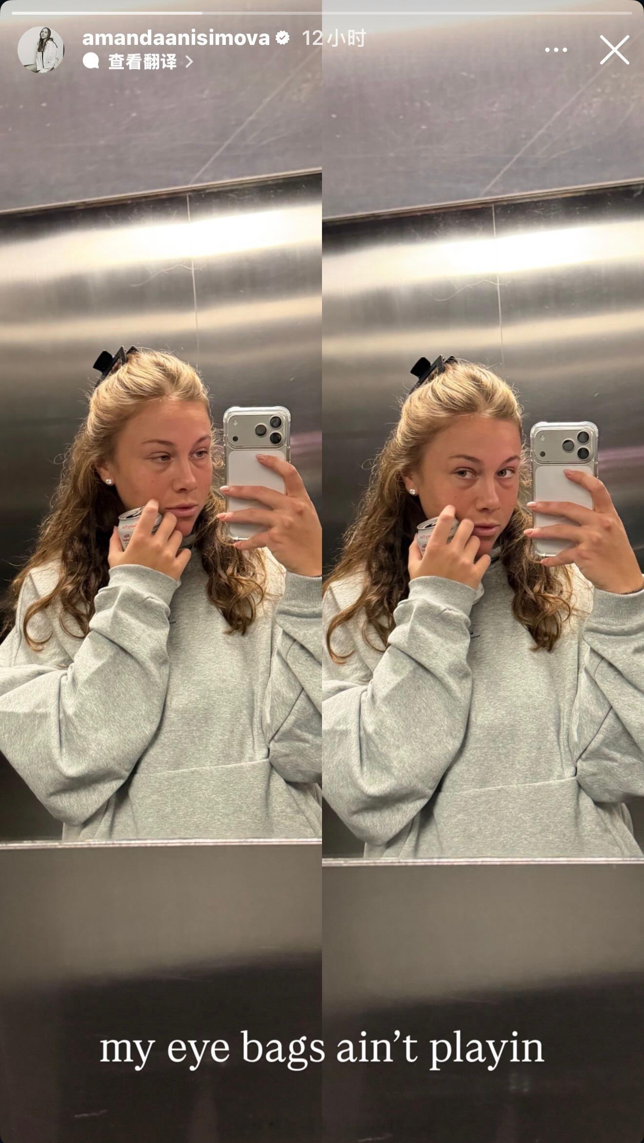 笑死，阿尼西莫娃吐槽自己的眼袋。