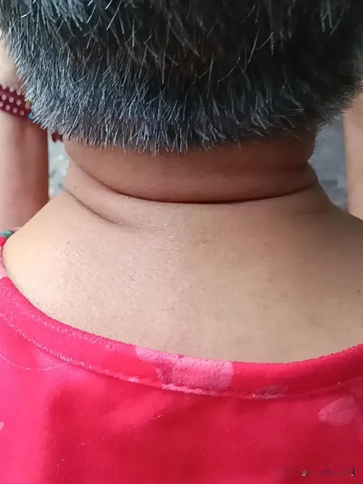 颈椎病为什么会头疼？颈椎本身就是给头部输送气血的关键通道，一旦曲度变直、肌肉僵