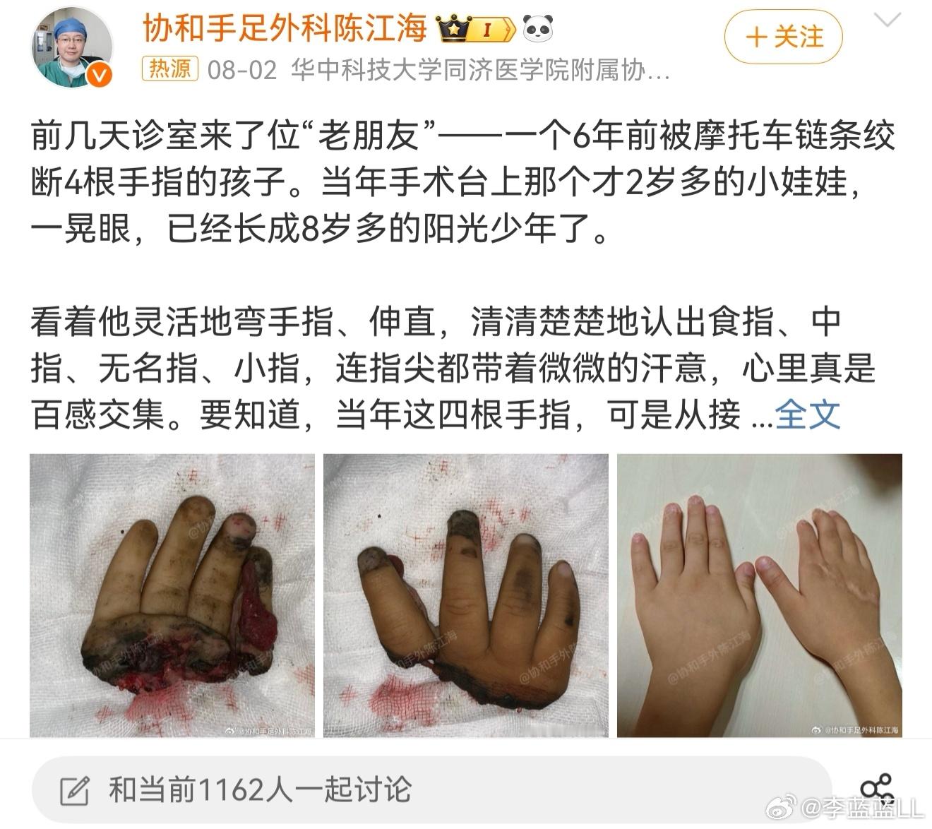 男童被绞断4根手指已恢复如初天啊！这医学奇迹网友们看得都心潮澎湃的！这医生太