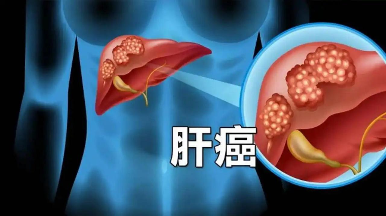肝部开始癌变，不是看肚子疼不疼，医生：若有5个症状，快去就诊肝脏是人体非