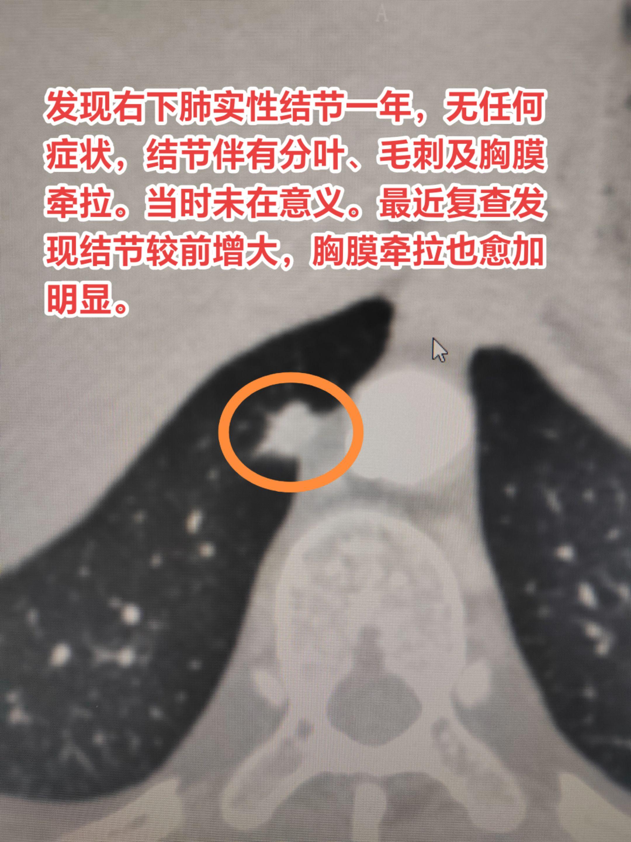 靠近胸膜的实性结节如怀疑恶性需要尽早处理。发现右下肺实性结节一年，无任...